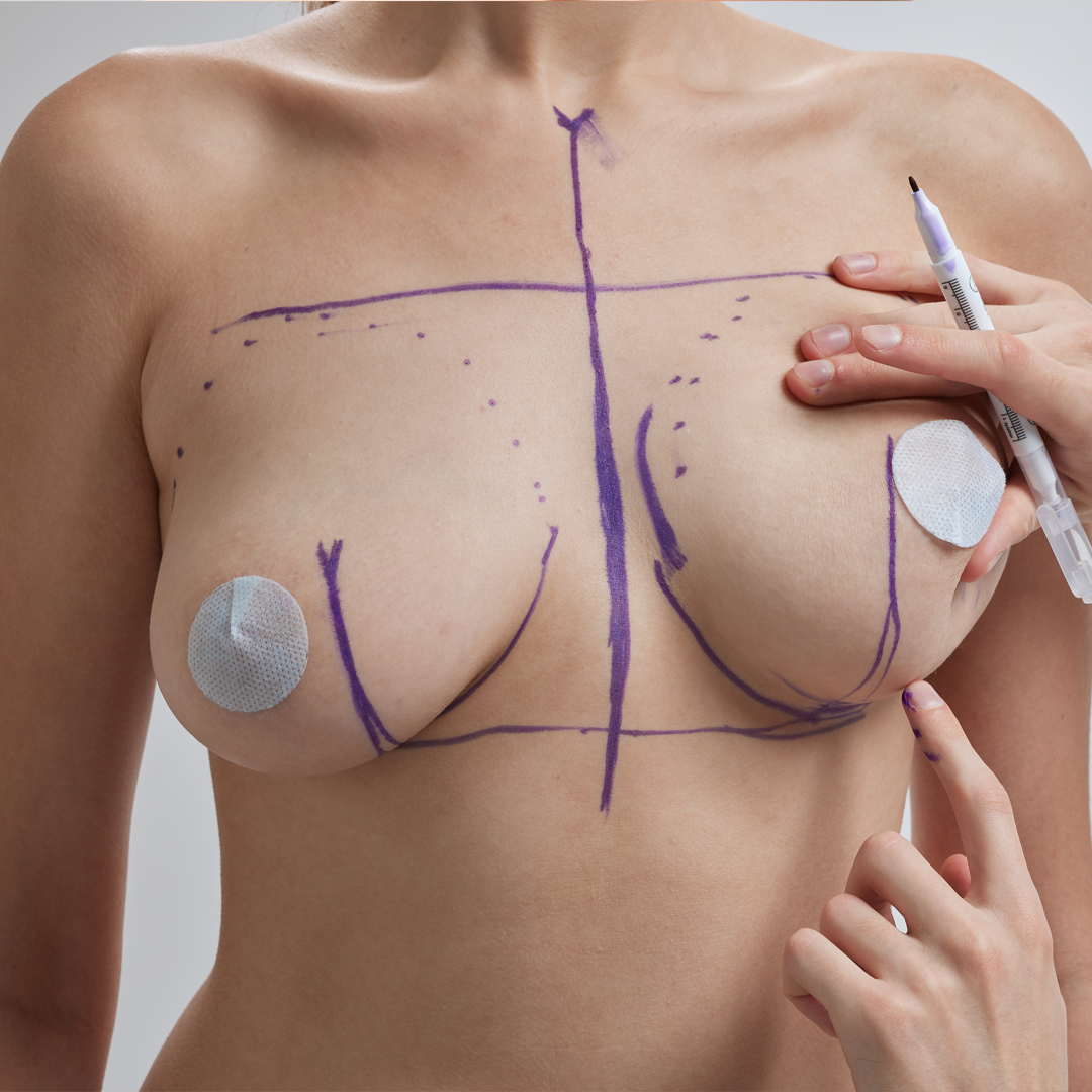 Breast Lift Surgery