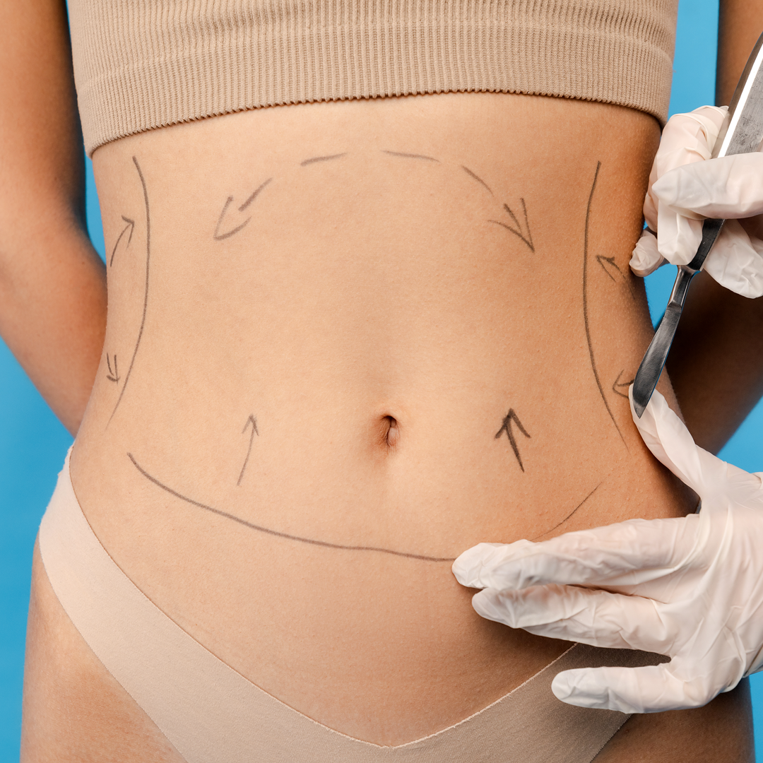Tummy Tuck