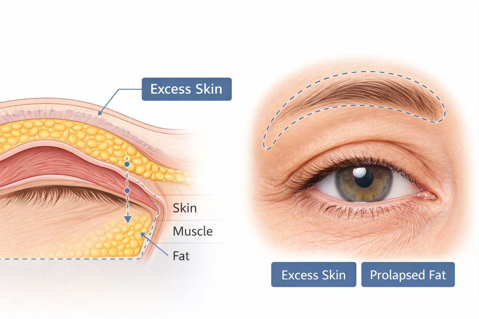 Göz kapağı estetiği, estetik kaygıların yanı sıra bazı hastalarda görme alanını etkileyen fonksiyonel sorunların değerlendirilmesiyle planlanan cerrahi bir işlemdir.